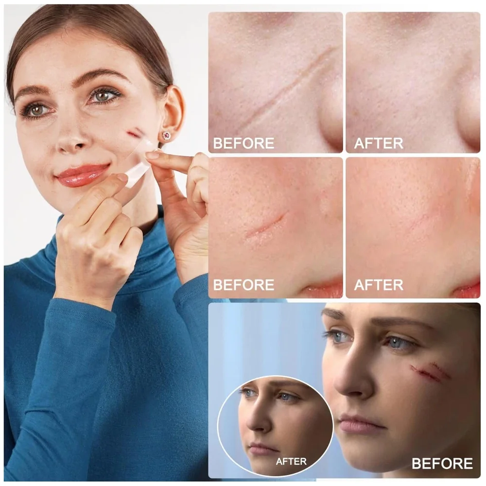 Clear Silicon Scar Sheet 4 x 150 Cm for Healing Scars Transparent tear silicone tape roll for hypertrophic scars and keloids caused by surgery, medical silicone for scar removal